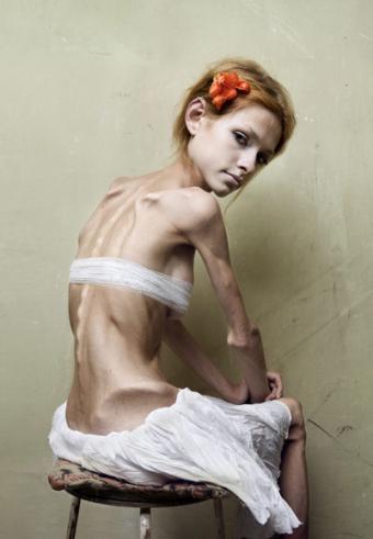 Anoreksja - anoreksja...jpg